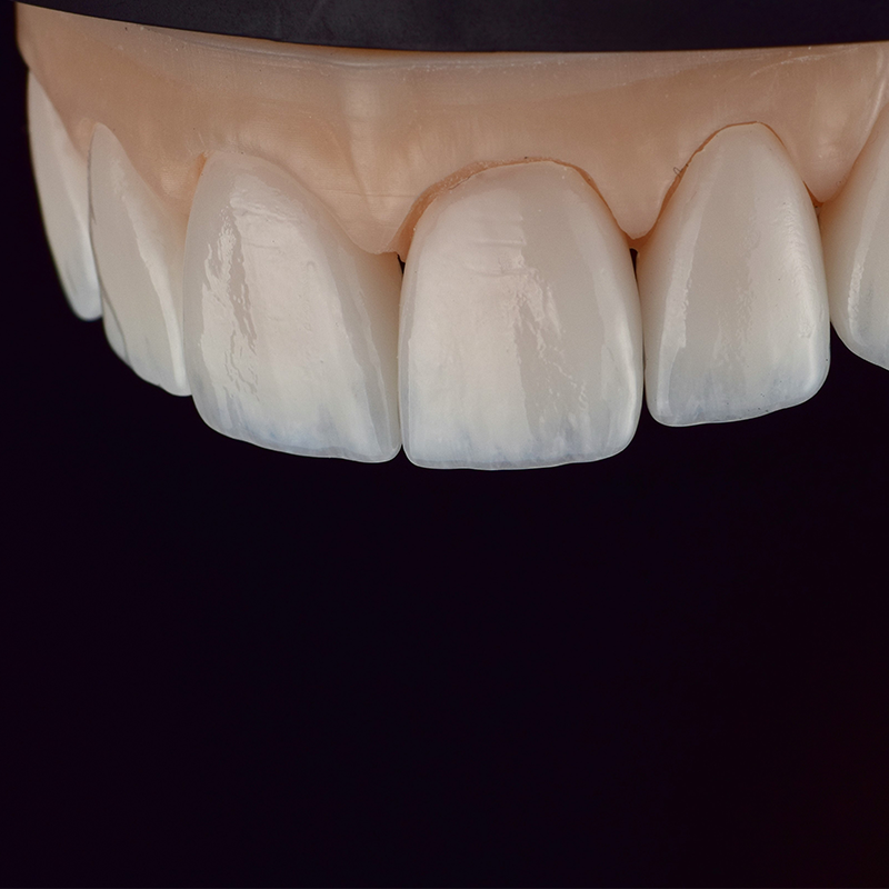 tooth1