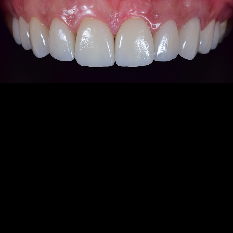 tooth3