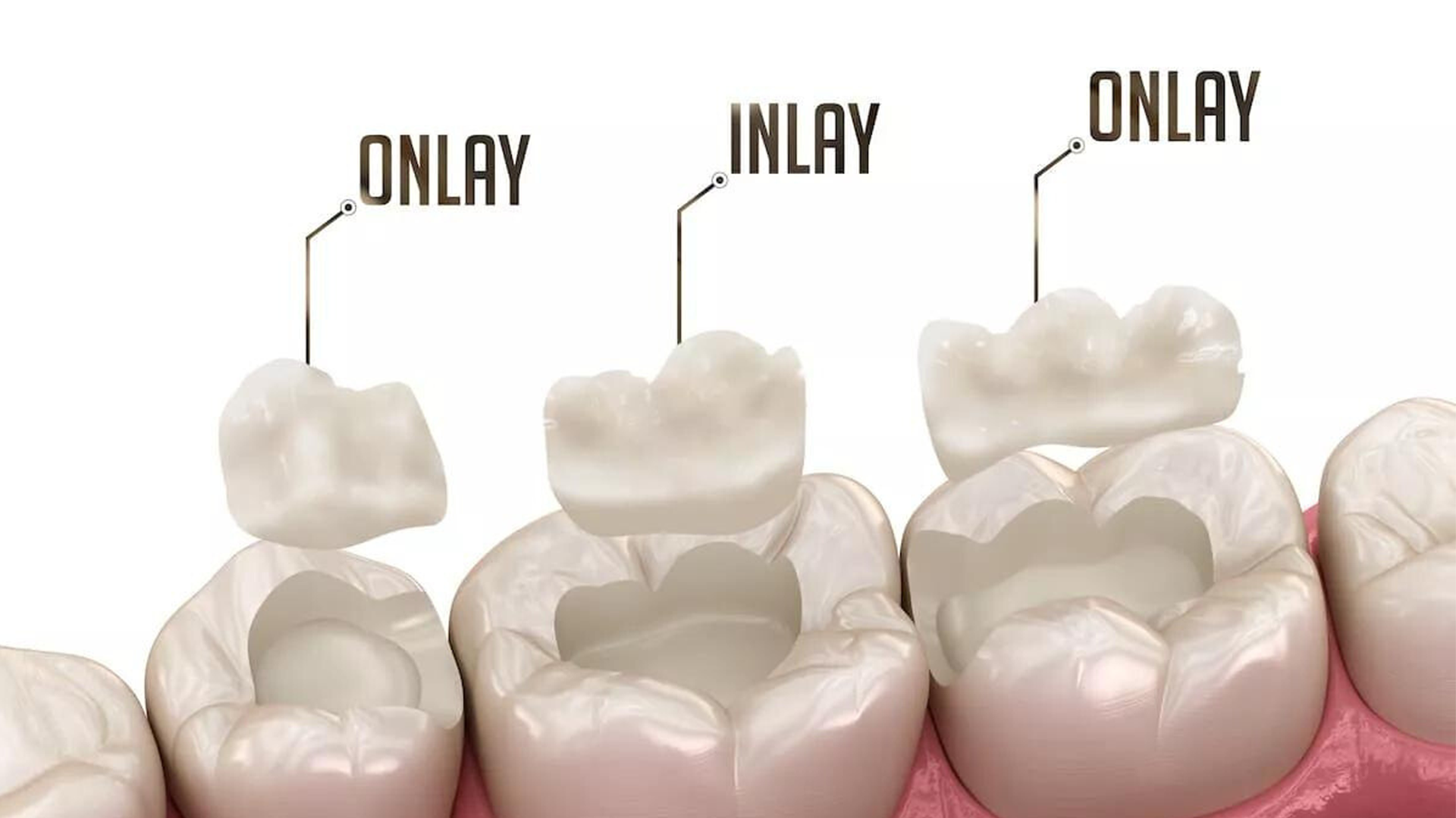 Ceramic Inlays or Fillings – Which Is the Better Choice