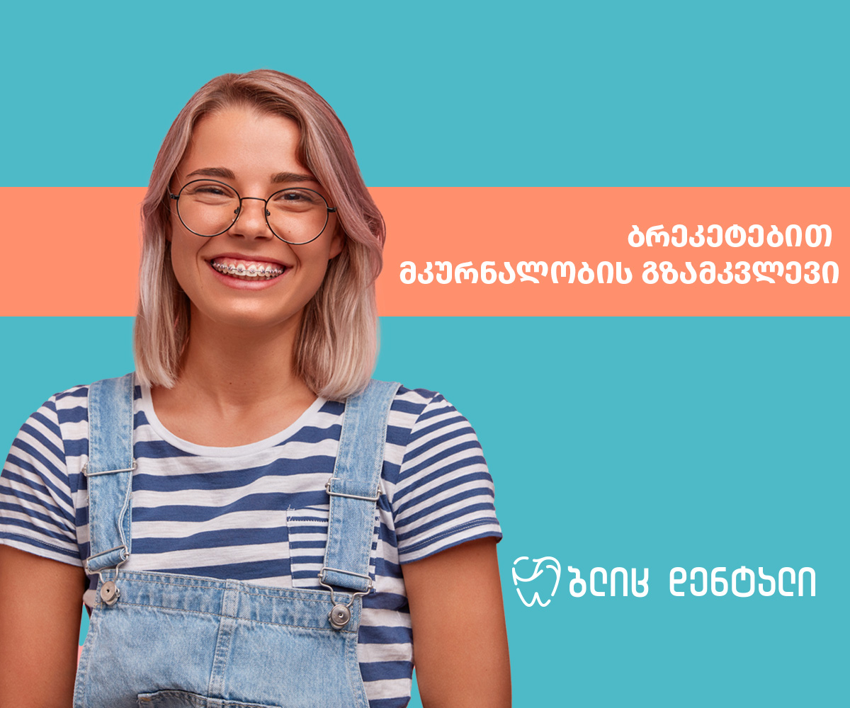 ბრეკეტებით მკურნალობა: ყველაფერი, რაც უნდა იცოდეთ სანამ მკურნალობას დაიწყებთ