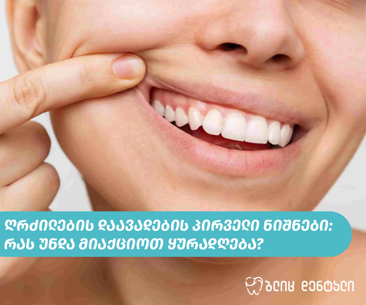 ღრძილების დაავადების პირველი ნიშნები: რას უნდა მიაქციოთ ყურადღება?