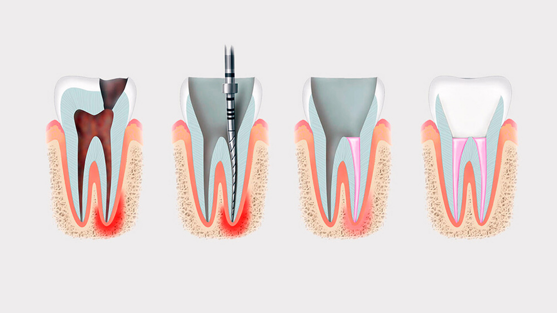 Root Initial Root Canal Retreatment – When Is It Necessary and How Does It Differ ...
