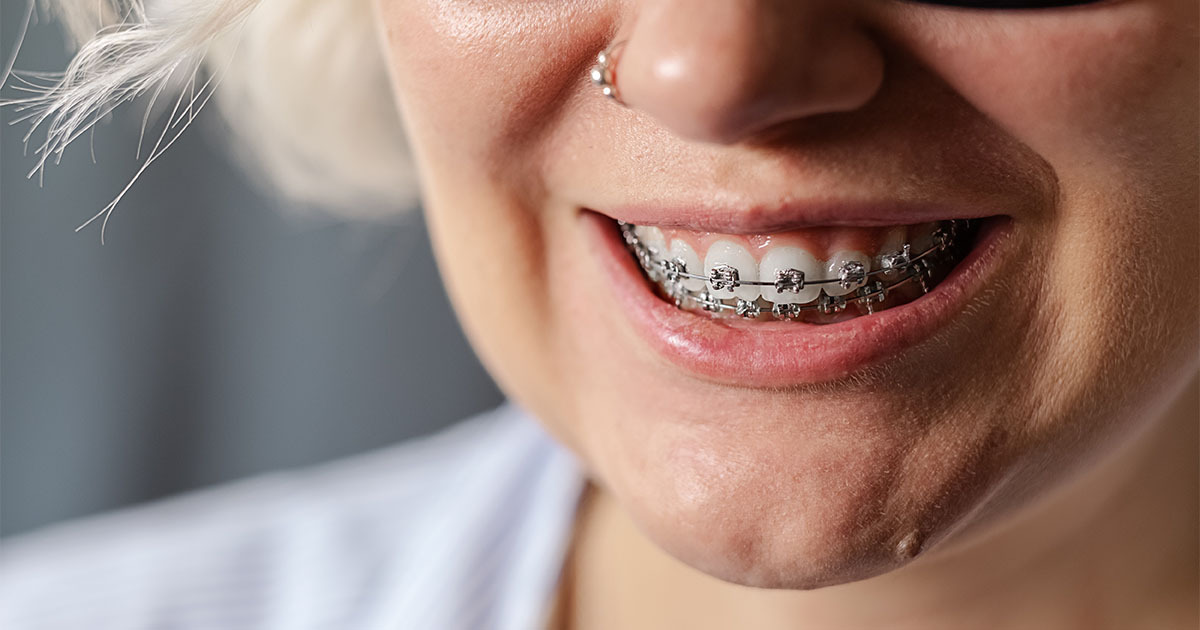 Braces Treatment in Adults