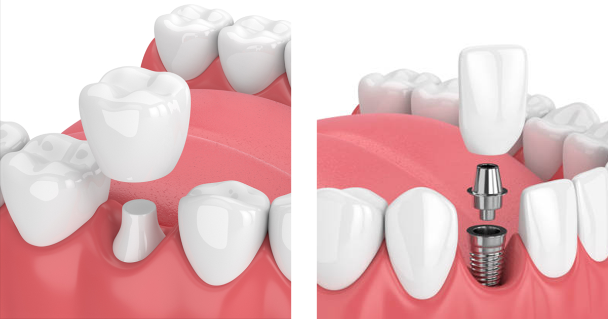 Dental Implants And Artificial Crowns