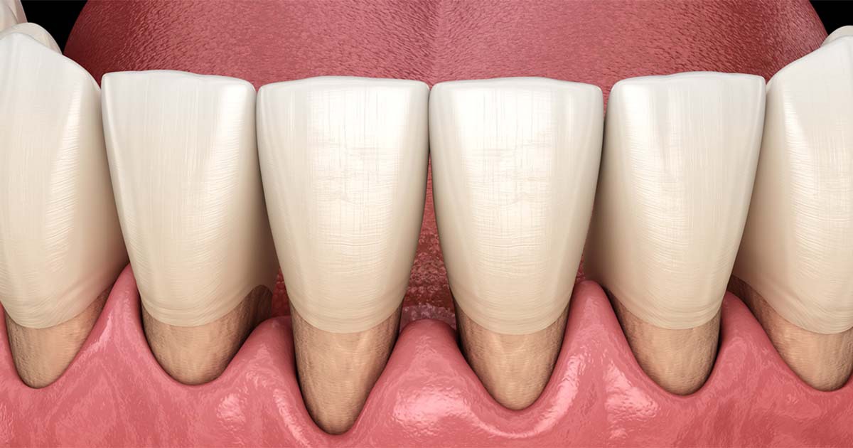 What causes gingival recession?